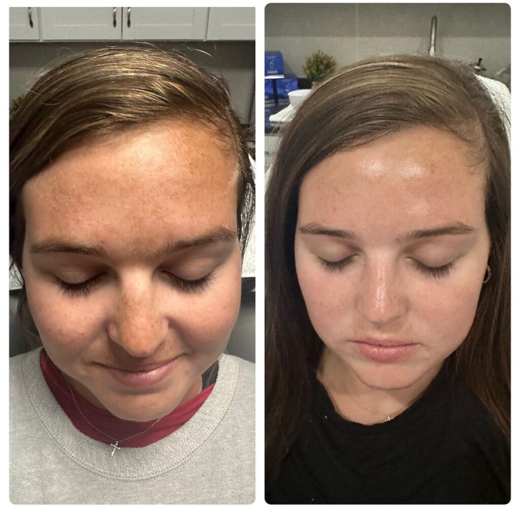 Chemical peels, vi peel, zo skin health peel