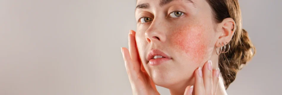 Sensitive Skin and Rosacea Facial in Goldsboro NC