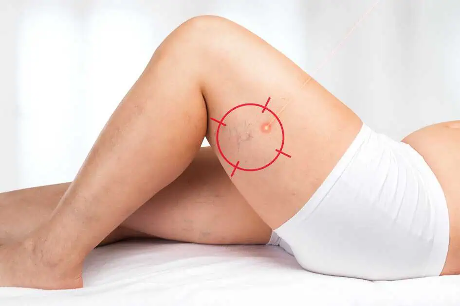 Laser Vascular Treatment for Spider Veins in Goldsboro, NC by Natural Beauty Aesthetics, PLLC