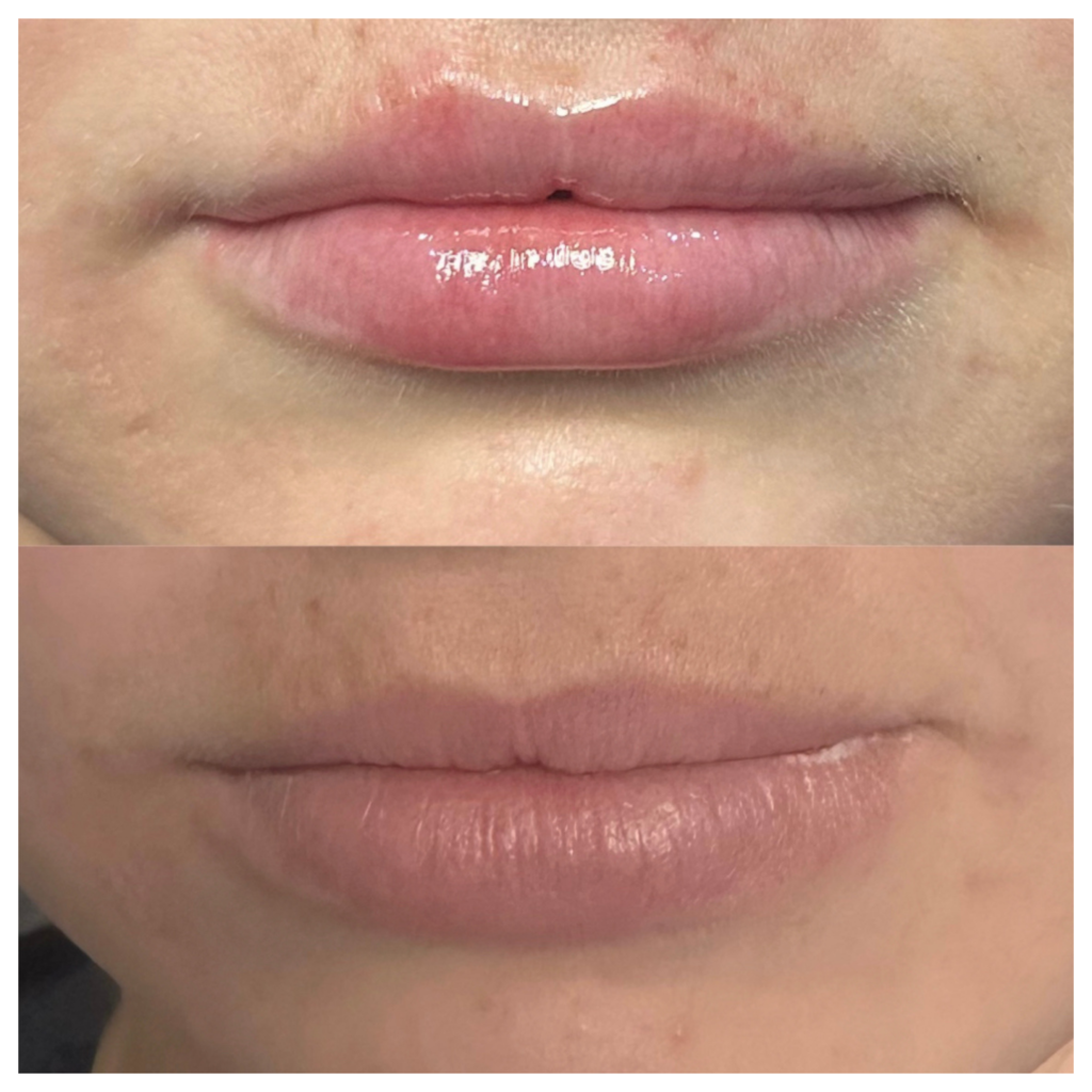 Lip filler, dermal filler