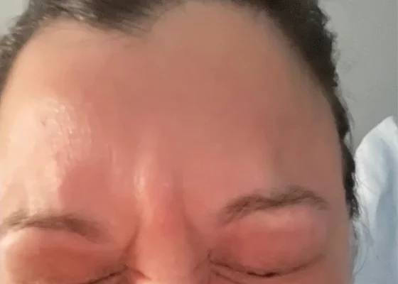natural-beauty-aesthetics-dermaplaning-after natural-beauty-aesthetics-dermaplaning-after
